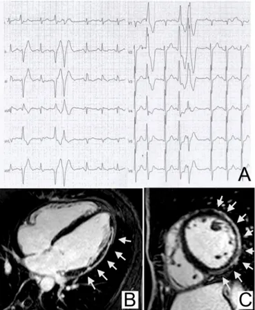 figure 3  Premature ventricular beats with a right bundle branch 