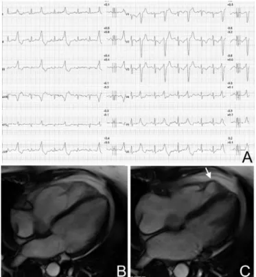 figure 4  Premature ventricular beats with a left bundle branch 