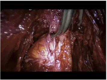 Figure 2 Shaving of a rectosigmoid nodule involving the uterosacral ligaments and retracting the bowel.