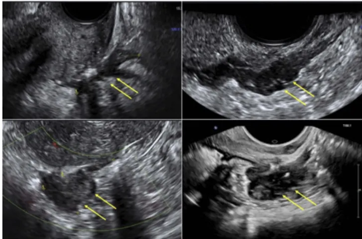 Figure 3 Ultrasound appearance of different nodules of deep inﬁltrating endometriosis of the bowel.