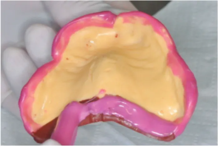FIG. 1  The conventional impression tray also records  peripheral areas such  as oral vestibule and soft palate.