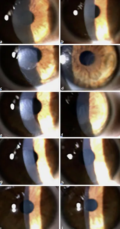 Fig. 2.  Digital slit lamp images of the corneal surface of the right eye (left column) and of the left eye (right  column) during follow-up