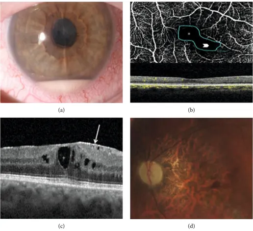Figure 1: Sight-threatening complications of Behçet’s syndrome- (BS-) related uveitis encountered in our cohort: (a) anterior chamber hypopyon in a case of BS-related panuveitis complicated with synechiae and cataract (right eye); (b) BS-related posterior 