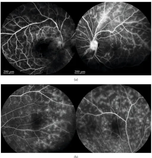 Figure 3: Fluorescein angiography (FA) ﬁndings in a patient with severe retinal vasculitis; (a) late-phase FA showing optic disc and vascular leakage and areas of nonperfusion in a Behçet ’s syndrome (BS) patient with a bilateral severe occlusive vasculiti