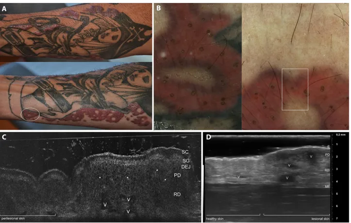 Figure 1. (A) Severe persistent tattoo reaction from red dye. (B) Dermoscopic examination (×20) of a swelling elevated area (white circle in  A) highlights the presence of yellowish circles within the stained skin corresponding to perifollicular openings f
