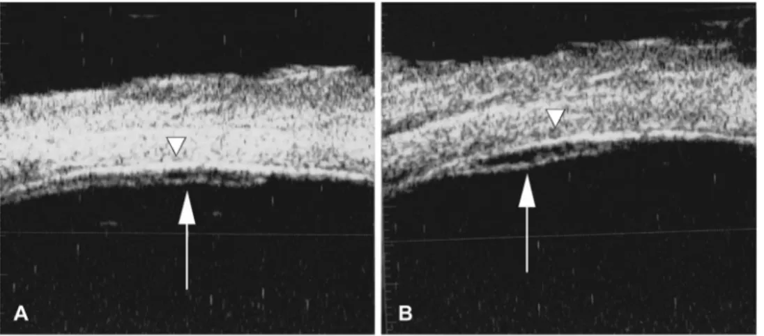 Figure 4 presents the distribution of vitreous incar- incar-ceration patterns for each subgroup of trocar type and vitrectomy gauge, summing up all sclerotomy sites (total number: 253 sclerotomies)