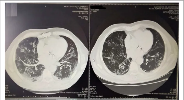 FIGURE 3 | CT chest in 67 years old patient at T0 (Left) and at day 14 of treatment (Right).