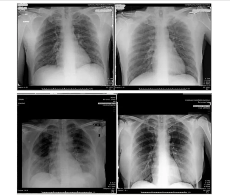 FIGURE 4 | CXR at T0 and after 48 h of ruxolitinib treatment in two patients.