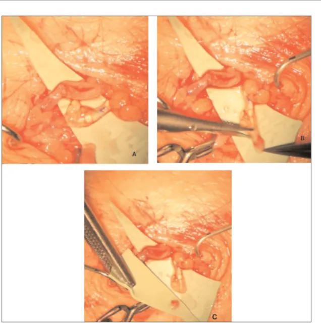 Figure 1. Intraoperative image of the super microsurgical lymphatic-venular anostomosis (s-LVA) during the collection of biopsy specimen.