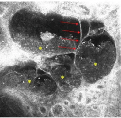 Figure 2. Handheld reflectance confocal microscopy examination of an angiokeratoma. Hypo-reflective oval areas separated by fine septa ( → ) and containing hyper- and medium-reflective cells are visible (*).