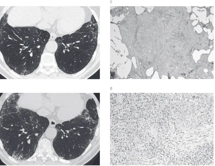 Figure 1. Examinations of a 66-year-old patient, a worker formerly exposed to asbestos