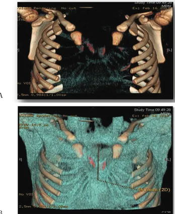Figure 3 a-b: Three-dimensional reconstruction of CT images showed  the presence of a congenital diastasis of sternal manubrium (37 mm)  with agenesis of the corpus sternum, with V-shaped cartilages (24  mm cranio-caudal diameter).