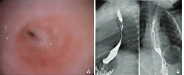 Figure 1. A 3-year-old female patient with an accidental caustic ingestion: (A) shows an endoscopic picture of esophageal stenosis, and (B) shows an x-ray image of esophageal stenosis.