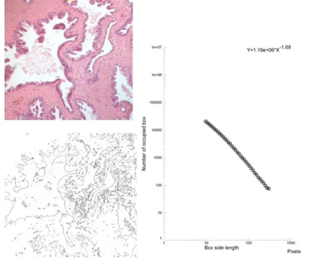Figure 2: Hematoxylin-eosin stained prostate specimen in a healthy subject (top)- original magnification  x 40; its contours obtained after segmentation   (bottom, left, JMicroVision software); its log-log plot obtained by fractal analysis (bottom, right, 