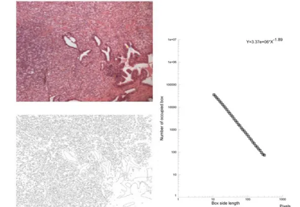 Figure 3: Hematoxylin-eosin stained prostate cancer  (top)- original magnification  x 40; its contours obtained after segmentation (bottom, left, JMicroVision  software); its log-log plot obtained by fractal analysis (bottom, right, Benoit 1.3, software)