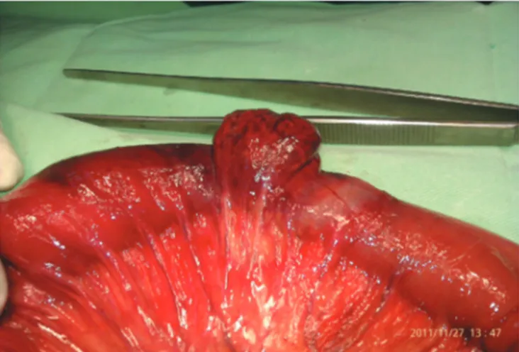 Figure 1. Meckel’s diverticulum with a part of the small  intestine˝which was in hernia sac
