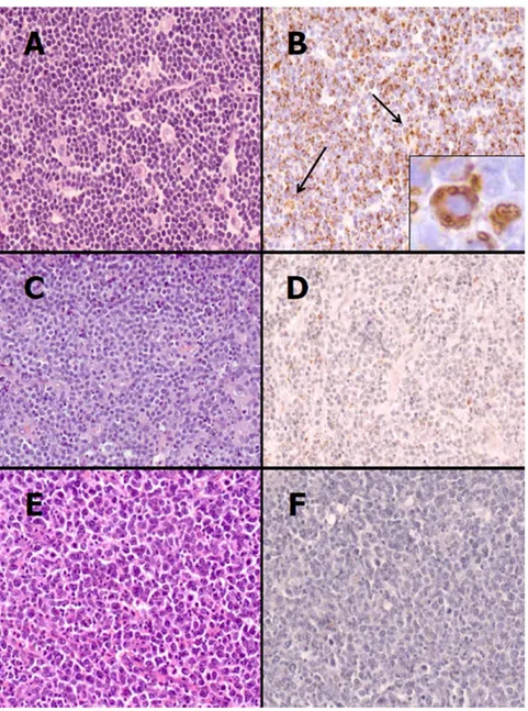 Figure 4. Adipophilin immunostain in BL and not-BL cases. (A) BL is characterized by medium-sized cells with a monotonous cohesive pattern of growth, round nuclei with finely clumped and dispersed chromatin, a high proliferation rate and ‘‘starry-sky’’ app