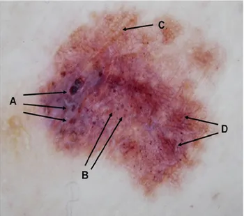 Figure 11b. Seborrheic keratosis with comedo-like openings (A) 