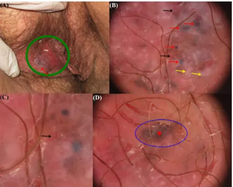 Figure 3. Clinical (A) and dermoscopic examination (B, C, D) of the second case of vulvar 