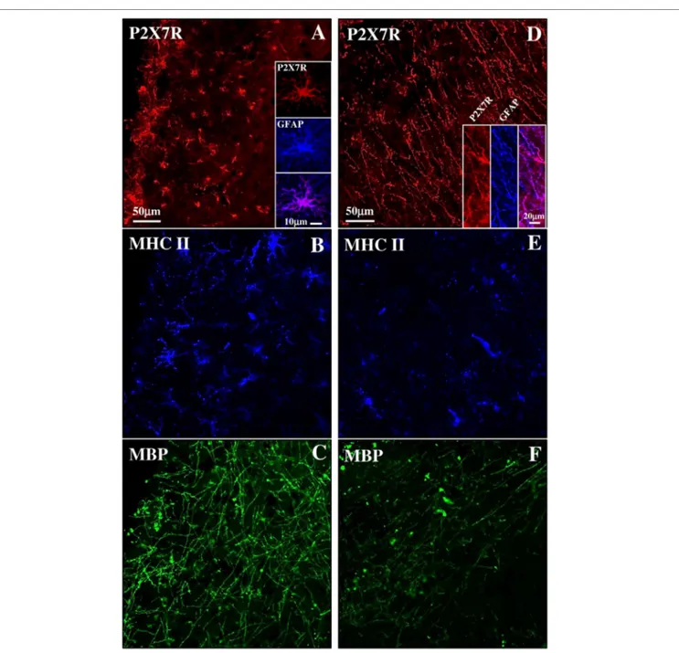 FigUre 5 | P2X7 receptor (P2X7R) expression in both active and inactive subpial lesions of secondary progressive multiple sclerosis (SPMS) frontal cortex