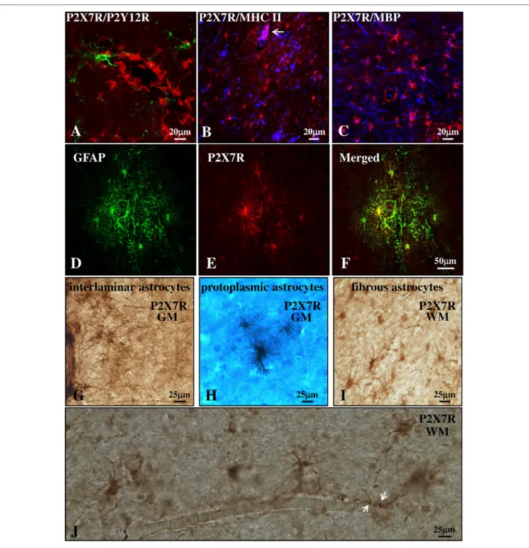 FigUre 3 | P2X7 receptor (P2X7R) is present on astrocytes in the parenchyma of secondary progressive multiple sclerosis (SPMS) frontal cortex