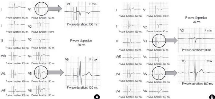 Figure 1.  Examples for measurement of P wave duration in 12 leads of two standard digitized paper-printed electrocardiogram (ECG) (A: healthy subject