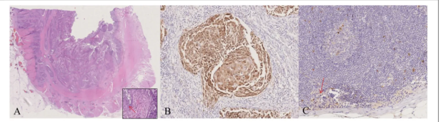 FIGURE 1 | Pathological characterization. The morphological and immunohistochemical evaluation of the surgical specimen showed the presence of a squamous cell carcinoma with basaloid features and koilocyte-like cells (arrow) (A, inset), and p16 expression 