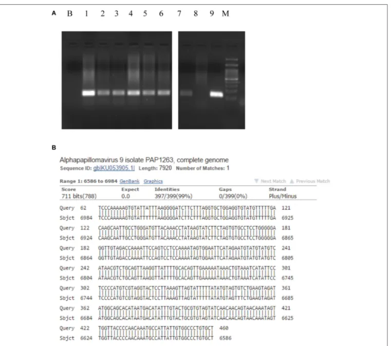 FIGURE 2 | Human Papillomavirus polimerase chain reaction identification and typing. The presence of HPV 16 DNA was confirmed by HPV 16 genotype specific primer pair 5 ′ - AAAGCCACTGTGTCCTGAAGA-3 ′ and 5 ′ -CTGGGTTTCTCTACGTGTTCT-3 ′ able to amplify a 130 b