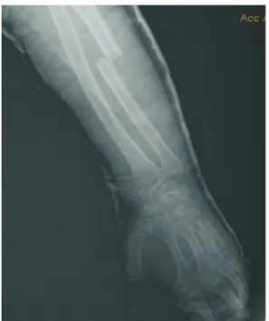 Figure 3.  The left ulnar shaft fracture and left carpal scaphoid.