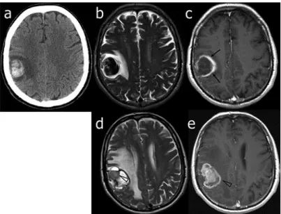 Fig.  1.   Patient  1.  Neuroimaging  at  diagnosis  and  follow-up.  On  admission,  CT  (a),  T2-weighted  (b)  and 