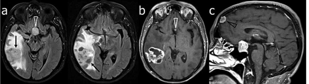 Fig. 2.  Patient 2. MR images of the brain on admission. Serial consecutive fat-suppressed fluid-attenuated  inversion recovery (a) and gadolinium-enhanced T1-weighted (b) axial images showed an inhomogeneous,  irregularly  contrast-enhancing  mass  lesion