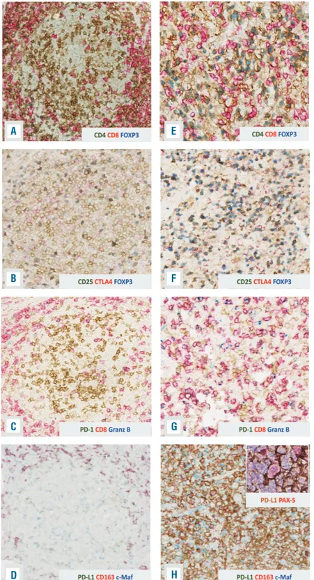 Figure 3. Time trend of evolution of the tumor microenvironment evolution. (A-D) In the  follic-ular lymphoma sample, the neoplastic follicles showed  a  low  number  of  regulatory  T  cells (A,B) and exhausted T cells (C)