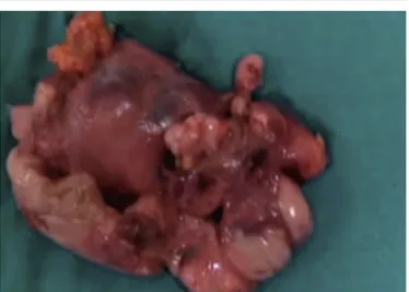 Figure 5. Hyperplastic thymic gland with perithymic fat.