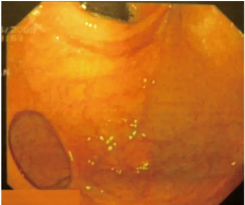 Figure 2  Endoscopic view of gastric diverticulum with a narrow neck. 