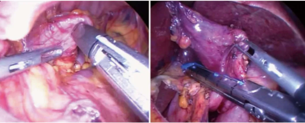 Figure 3  Exposure of the neck of the diverticulum for preparation of diverticulectomy and resection at the neck with a linear stapler
