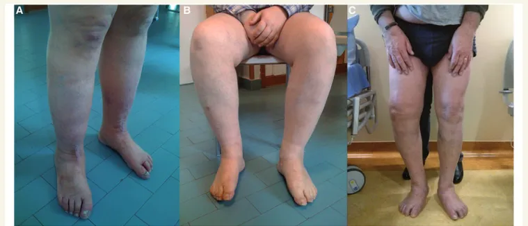 Figure 2 Pictures of patients’ limbs. (A) Patient K1 II-1; (B) Patient K2 III-1; (C) Patient K4 I-1.