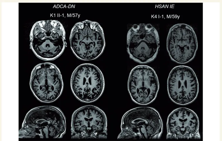 Figure 4 Brain MRI. Axial, sagittal and coronal reconstructions of volumetric high resolution FSPGR T 1 images of one patient with ADCA-