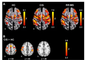 FIGURE 1 | Brain activation during mental squeezing ball movement (MM) with the right hand (A) in healthy controls (HC), clinically isolated syndrome (CIS) and relapsing-remitting multiple sclerosis (RRMS) groups and (B) comparisons between groups
