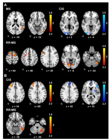 FIGURE 3 | Voxelwise correlations of brain activity during MM with the right (A) and left (B) hands and the corresponding index of performance (IP) scores for the whole group of MS patients, and separately for CIS and RR-MS patients