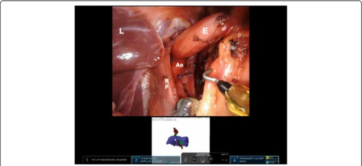 Fig. 4 Intraoperative view of the patient anatomy highlighting the “picture-in-picture” mode
