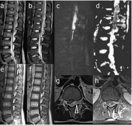 Fig. 1. Magnetic resonance imaging of the thoraco-lumbar spine at diagnosis: unenhanced T2-weighted (a), short tau inversion recovery (STIR) (b), diffusion-weighted (DW) (c), apparent diffusion coefﬁcient (ADC) map (d), and T1-weighted (e) sagittal and T2-