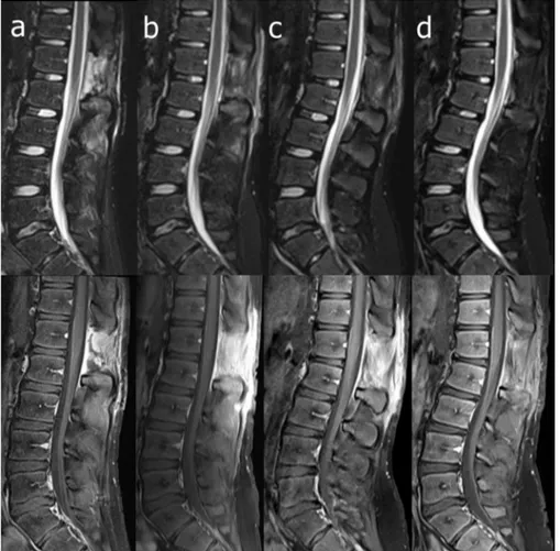 Fig. 2. Magnetic resonance imaging follow-up by STIR (upper line) and gadolinium-enhanced fat-suppressed T1-weighted (lower line) sagittal images obtained 24 days after surgery (a) and one month (b), three months (c), and seven months (d) later