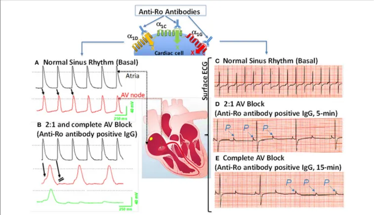 FIGURE 2 | Effects of anti-Ro antibodies from mothers of children with congenital heart block on an isolated multicellular AV nodal preparation (left) and Langendorff perfused whole heart (Right)