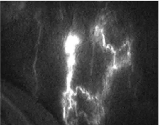 Figure 3. After scrotal injection of ICG we see a splash type lymphography. 