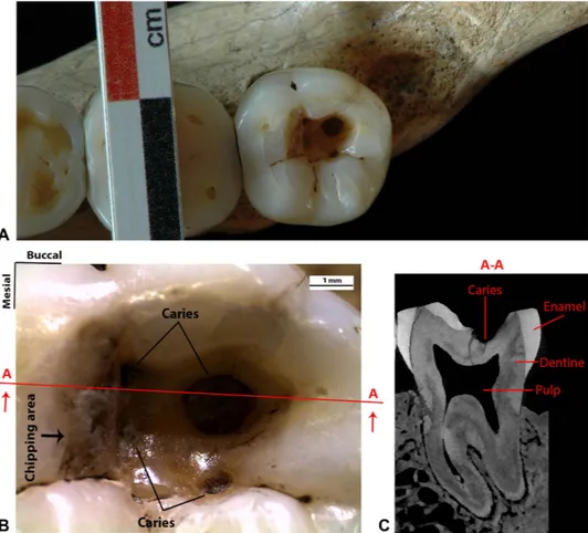 Figure 1.  The lower right third molar (RM 3 ) of the Late Upper Palaeolithic specimen known as 