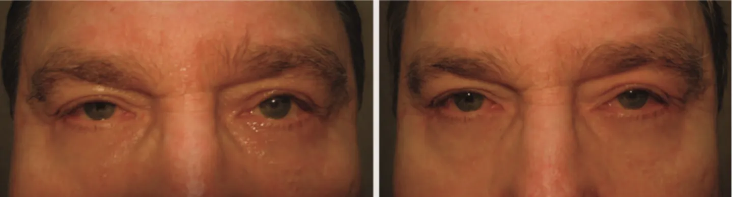 Fig. 2. Patient with cicatricial ectropion and retraction of lower eyelids after a cosmetic blepharoplasty before and after eyelid  manipulation.