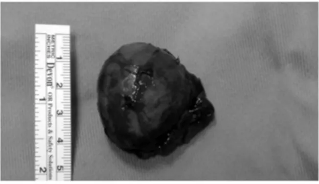 Figure 1. Intraoperative image of the excised tumor.