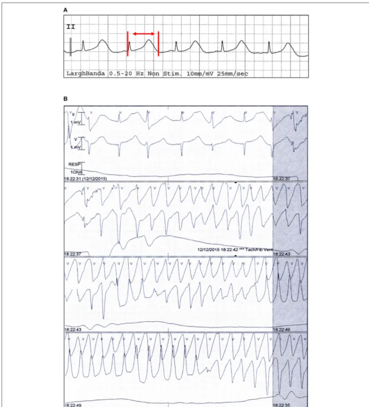 FIGURE 1 | Electrocardiographic findings of a patient with TdP and PPI-associated hypomagnesemia
