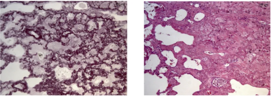 Fig. 2. Histological evaluation of VATS sampling. Pleural ﬁbroelastosys clearly separated from lung parenchymal tissue (on the left, hematoxylin-eosin staining; on the right, Weigert staining).