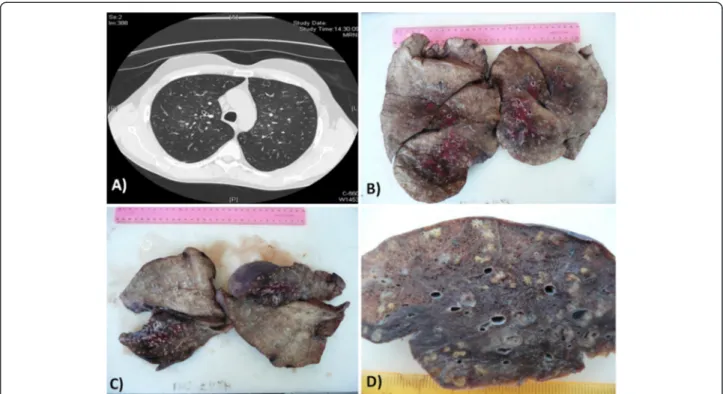 Figure 1 Chest HRCT scan and gross examination of the lungs. (A) HRCT scan: nodular shadows were distributed in a centrilobular fashion, often extending to small branching linear areas of attenuation ( “tree-in-bud” pattern); (B-D) gross examination of the